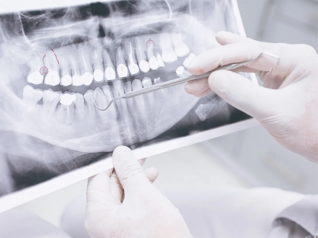Endodoncia