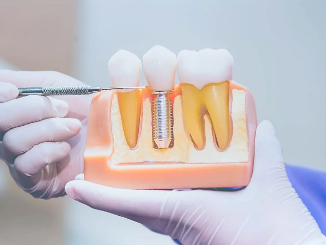 Implantes Dentales